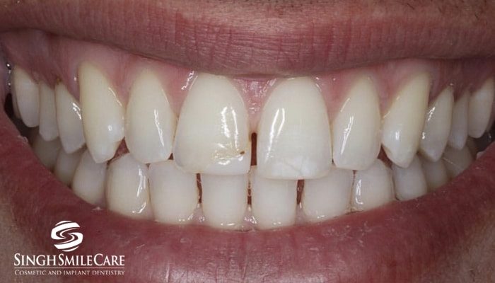 Before treatment