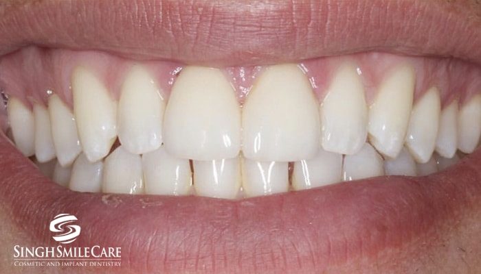 After treatment