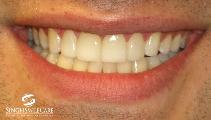 After treatment