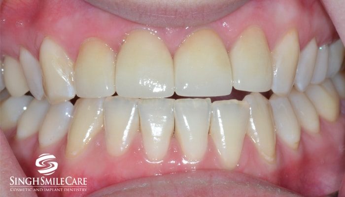 After treatment