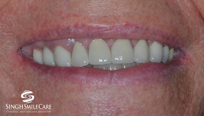 After treatment