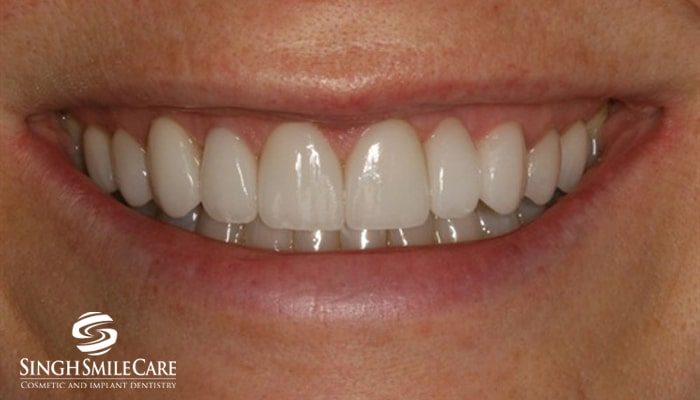 After treatment