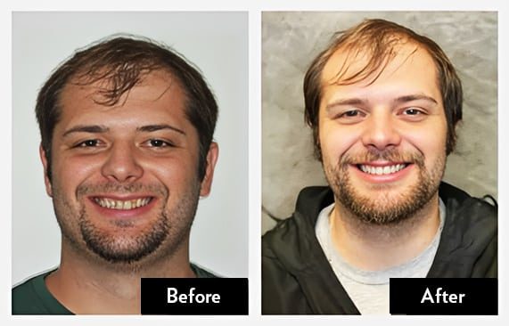Same-Day Dental Crowns