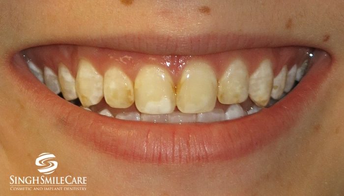 Before treatment