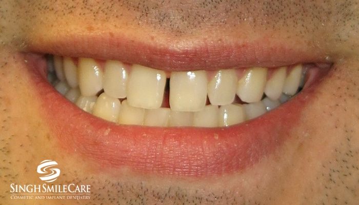Before treatment