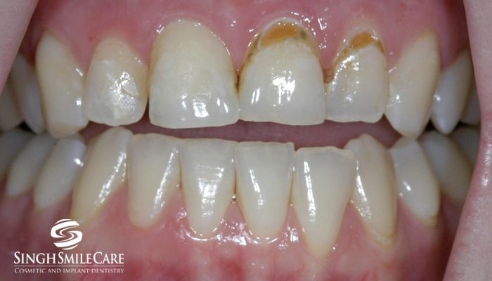 Before treatment