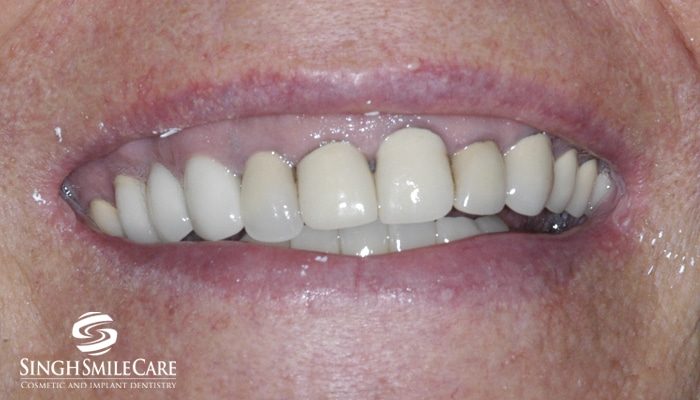 Before treatment