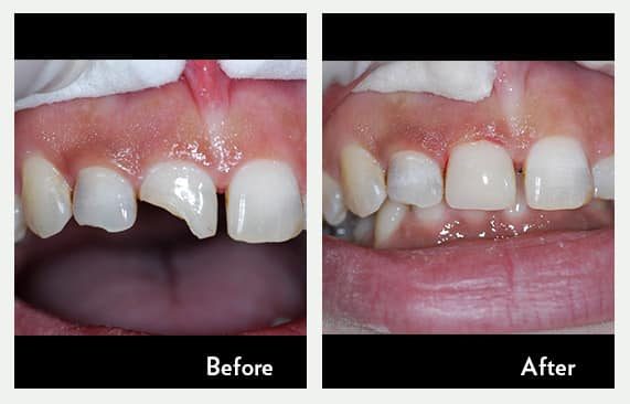 Chipped Baby Tooth — before and after