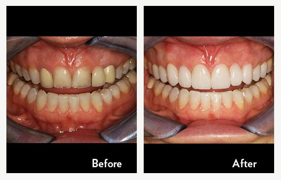Cosmetic Bonding Using Composite Resin — before and after