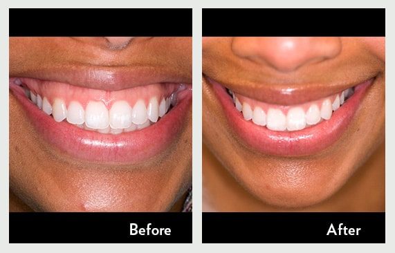 Cosmetic Crowns to Replace Decayed Teeth — before and after