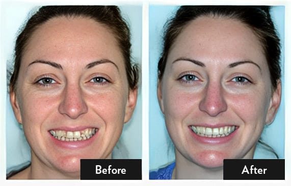 Cosmetic Porcelain Bridge — before and after