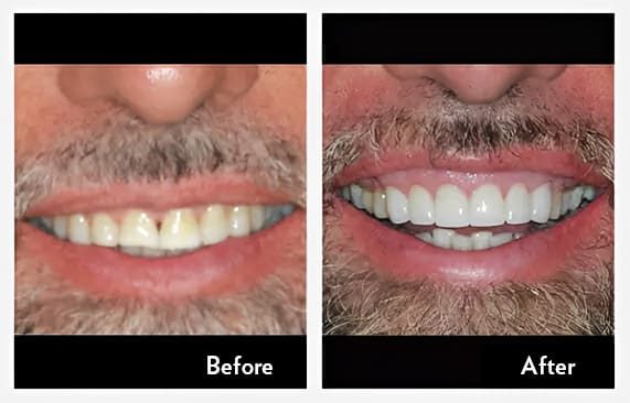 Full Upper Anterior Crowns — before and after