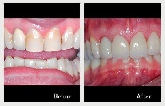 Gum Recession and Root Exposure — before and after