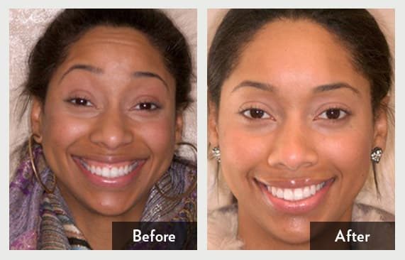 Gummy Smile – Laser Gum Surgery — before and after