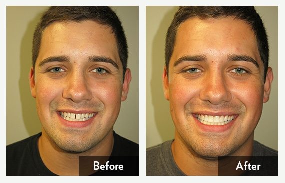 Lumineers — before and after