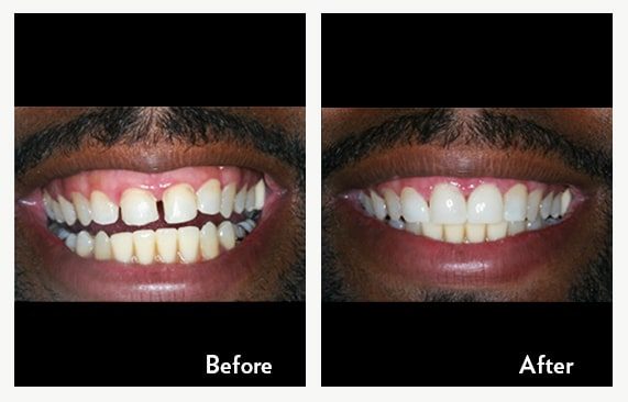 Dentures, Partials & Implant Dentures