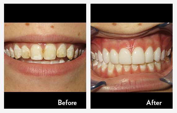 Six Month Smiles & Invisalign