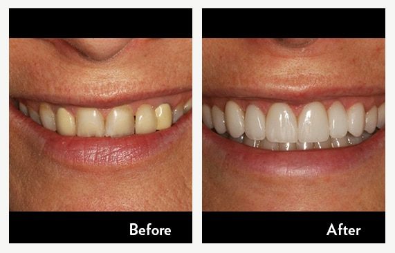 Smile Makeover – Full Mouth Rehabilitation — before and after