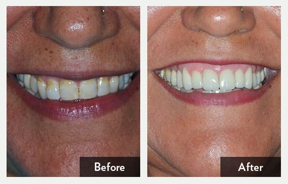 Smile Makeover With Beautiful Porcelain Crowns — before and after