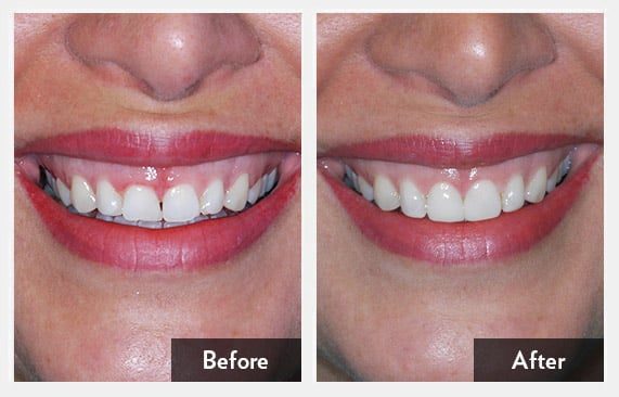 Smile Transformation — before and after
