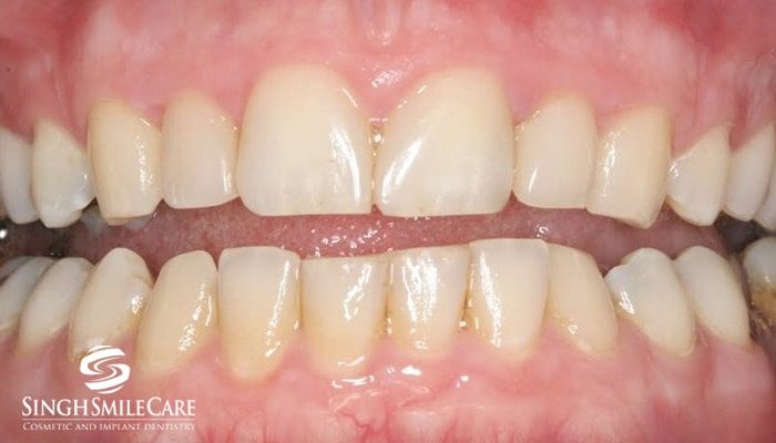 After treatment