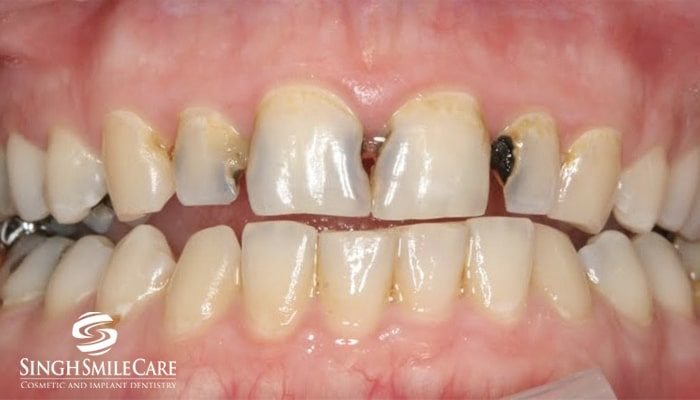 Before treatment
