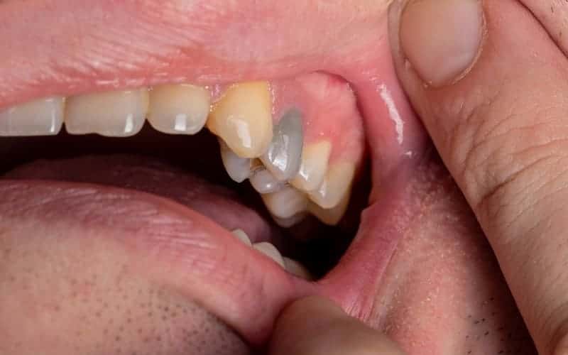 What Causes Black Teeth in Adults